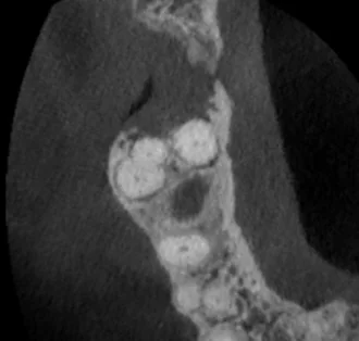 CBCT cross-section showing slightly irregular lucent lesion for throbbing tooth pain and eye case