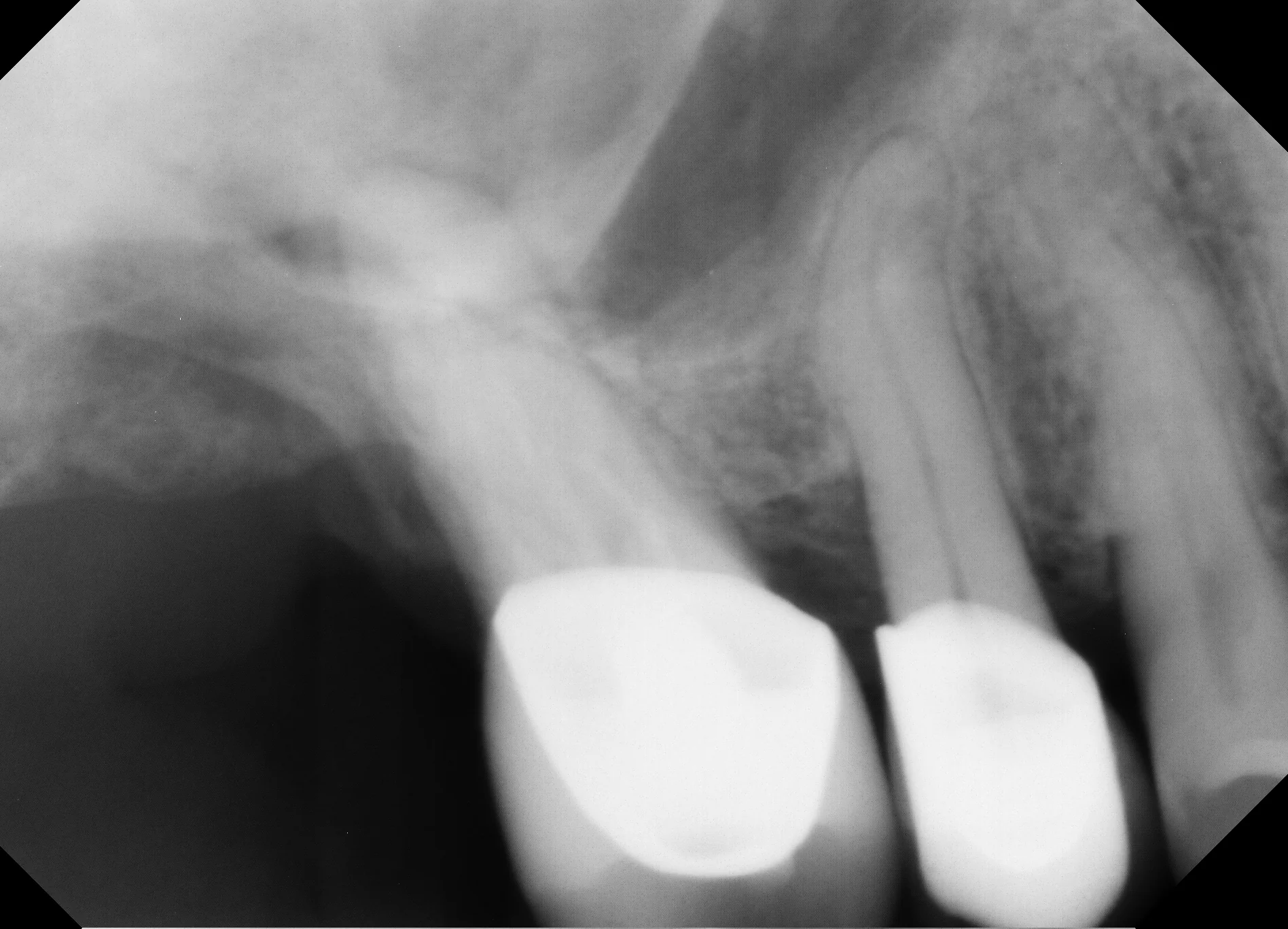 Periapical radiograph appearing normal despite underlying pathology — 2D imaging can be deceiving